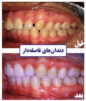 متخصص ارتودنسی برای درمان فاصله بین دندان‌ها