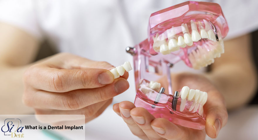  what is a dental implant