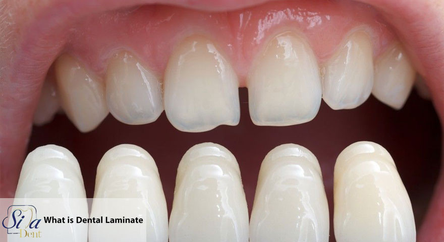 What Is a Dental Laminate 