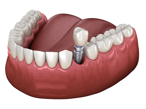 ایمپلنت یک دندان