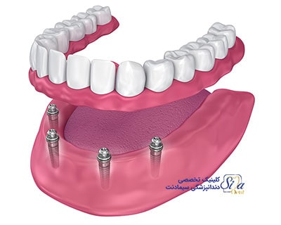هزینه دندان مصنوعی بر پایه ایمپلنت (هزینه اوردنچر)