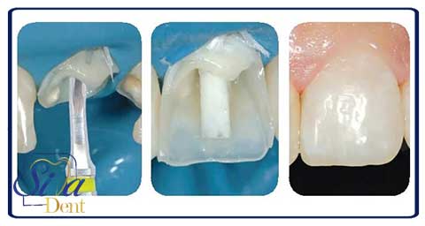 بیلداپ کامپوزیت دندان