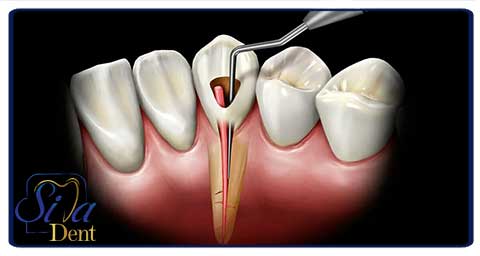 عصب کشی دندان و درمان ریشه دندان