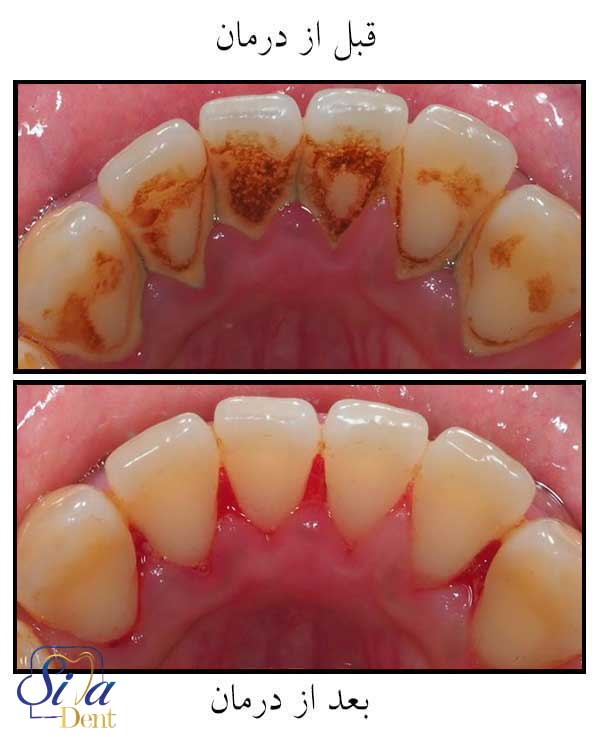 قبل و بعد از جرم گیری دندان