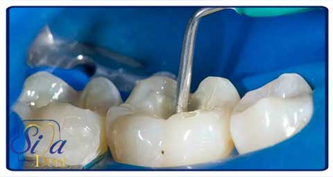 بازسازی و بیلداپ دندان