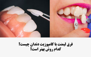 فرق لمینت با کامپوزیت دندان چیست؟