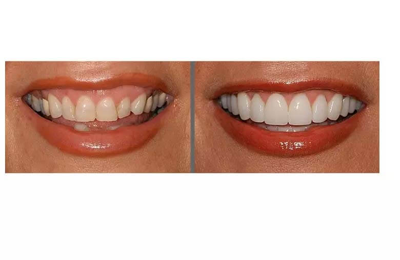 مزایا و معایب کامپوزیت و لمینت چیست؟