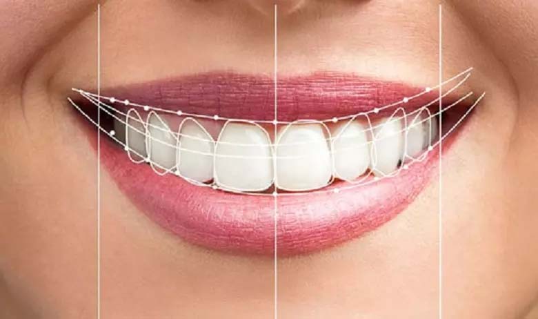 فرق لمینت و کامپوزیت چیست؟