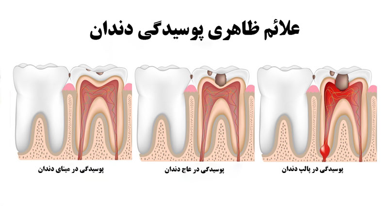 علائم ظاهری پوسیدگی دندان