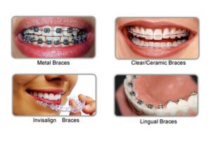 Type of Braces