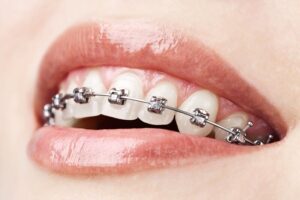 What is Fixed Orthodontics (Fixed appliances)