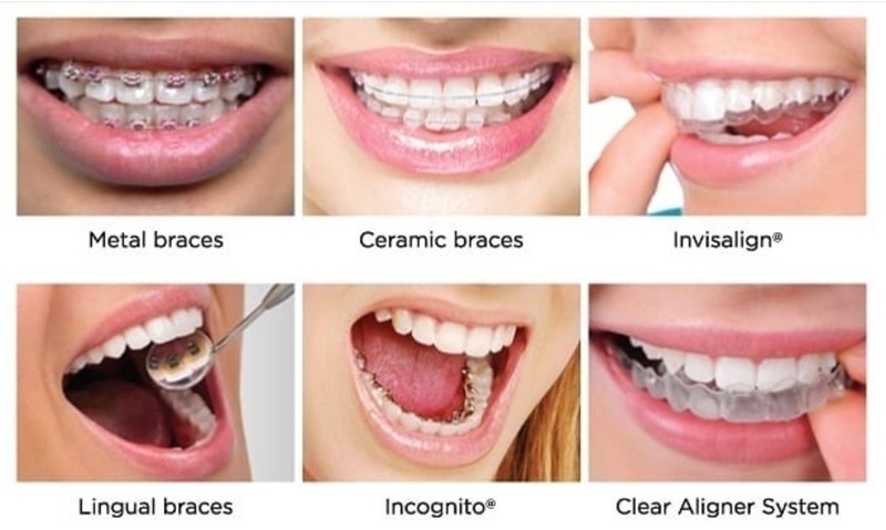 What Are Braces and How Do They Work?