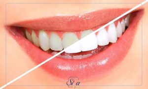 انواع روکش سفید دندان شیری و نحوه انجام آن