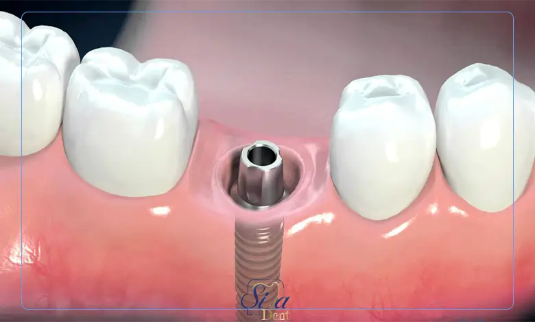 علائم پس زدن ایمپلنت