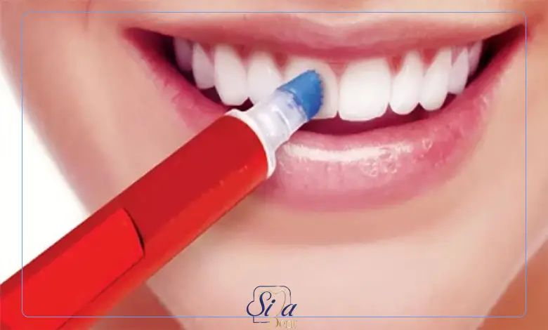 نحوه روکش کردن دندان شیری