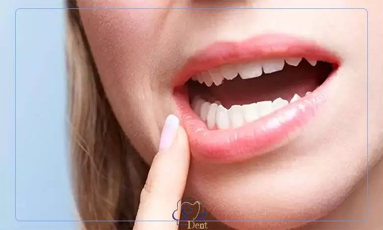 نشانه های ورم کردن لثه