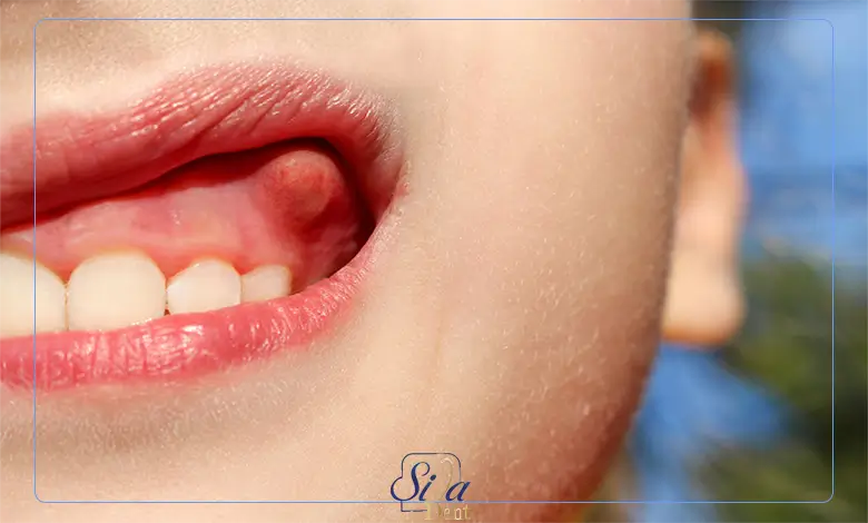 راه های پیشگیری از ورم لثه