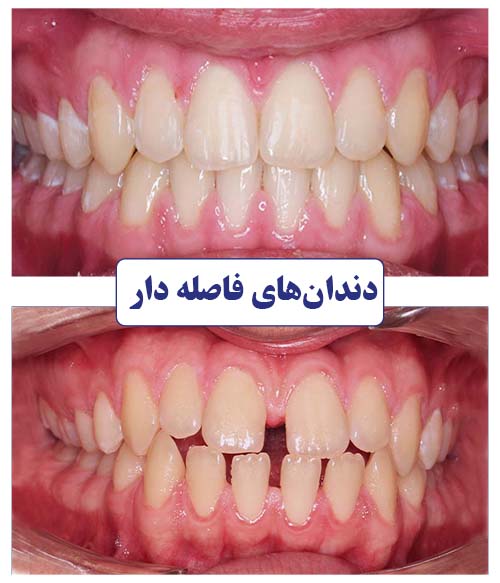 ناهنجاری دندانهای فاصله دار