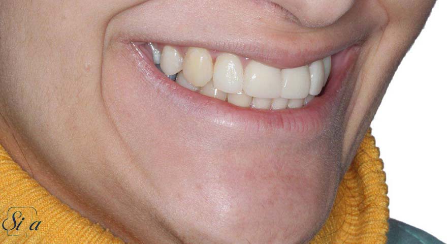 Smile Design in Tehran – iran