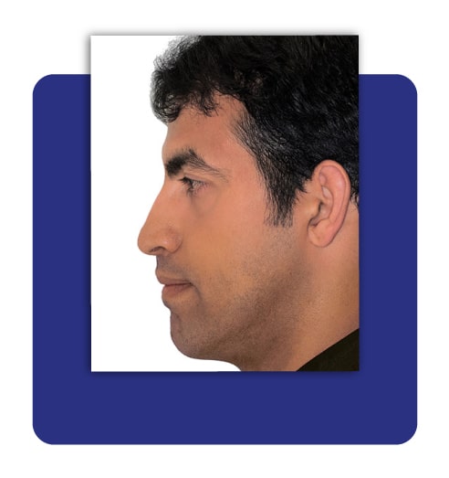 بعد از ارتودنسی و جراحی فک