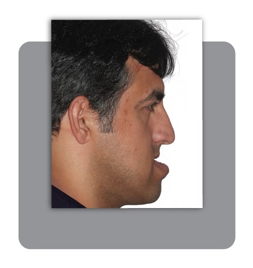 قبل ارتودنسی و جراحی فک