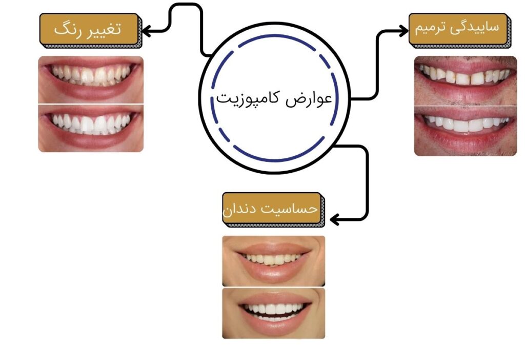 کامپوزیت دندان : عوارض کامپوزیت، عکس قبل و بعد + هزینه