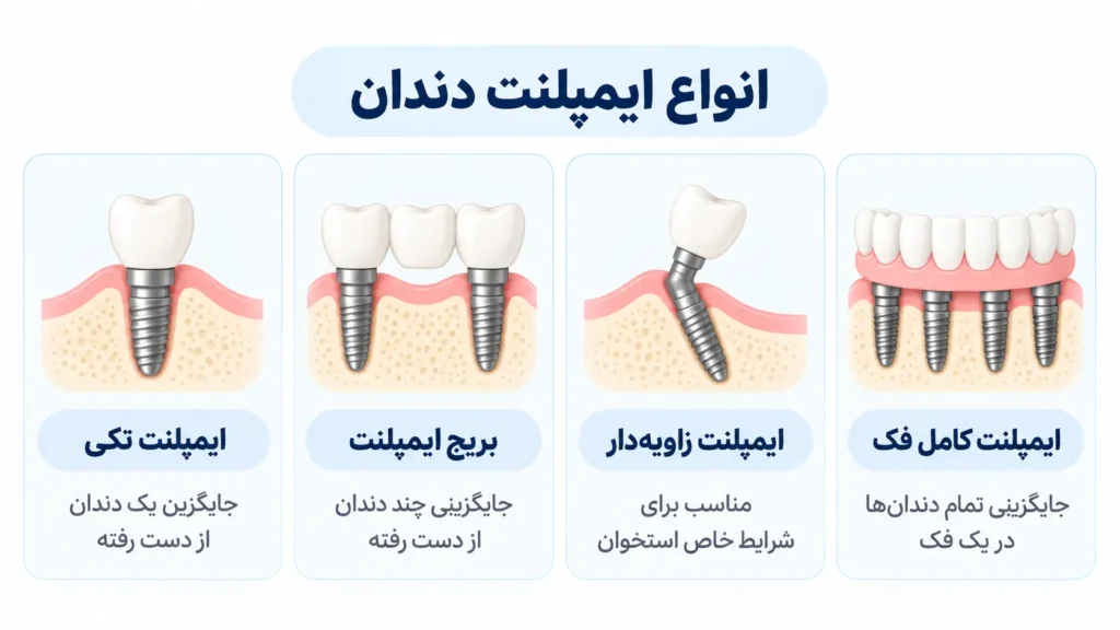 قیمت ایمپلنت دندان