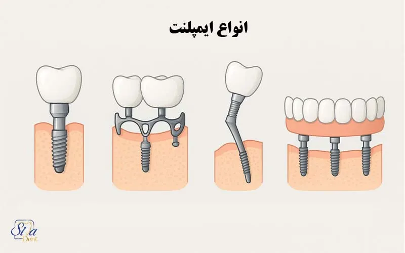 انواع ایمپلنت