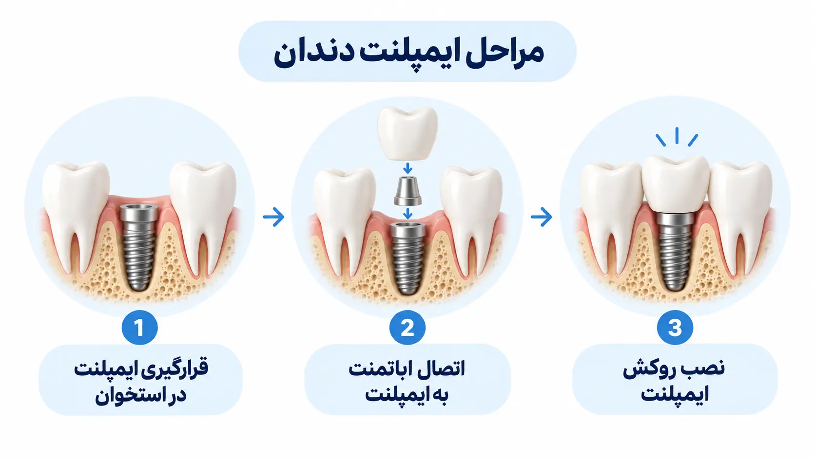 قیمت ایمپلنت دندان