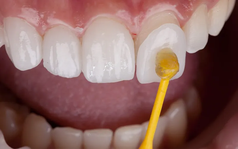 Dental laminate