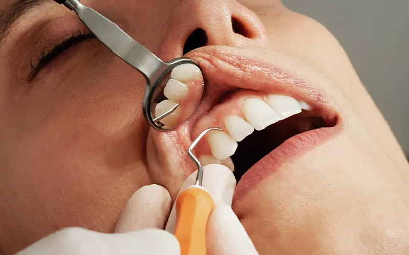 Dental plaque