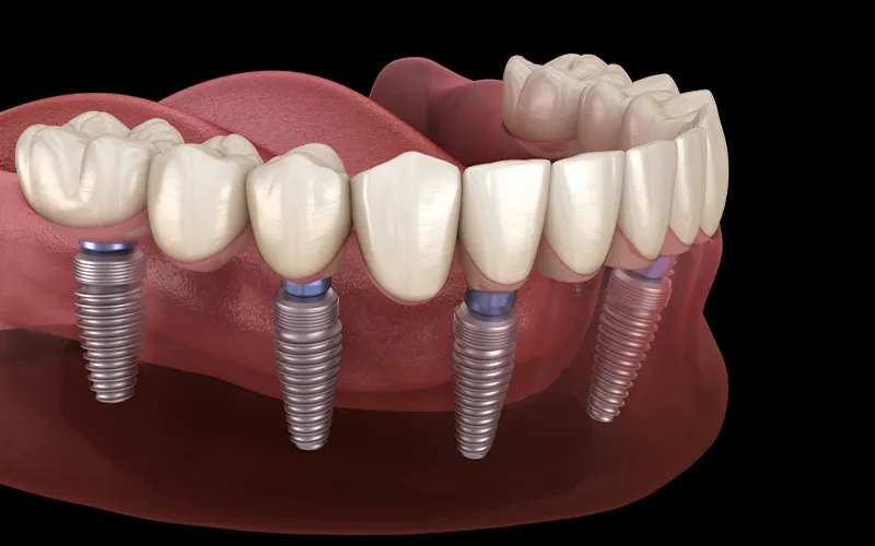Dental prosthesis
