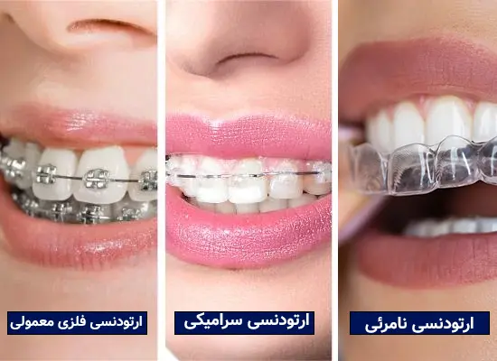 هزینه ارتودنسی دندان 1405 | جدول قیمت ارتودنسی (قسطی و بیمه)