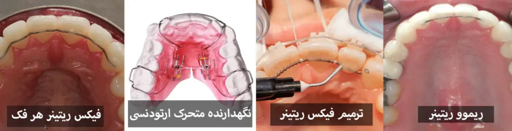 هزینه ارتودنسی دندان 1405 | جدول قیمت ارتودنسی (قسطی و بیمه)