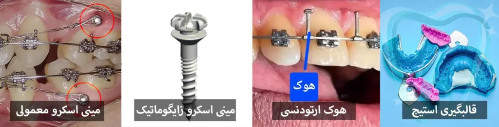 هزینه ارتودنسی دندان 1405 | جدول قیمت ارتودنسی (قسطی و بیمه)