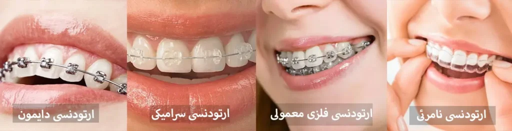 هزینه ارتودنسی دندان 1405 | جدول قیمت ارتودنسی (قسطی و بیمه)