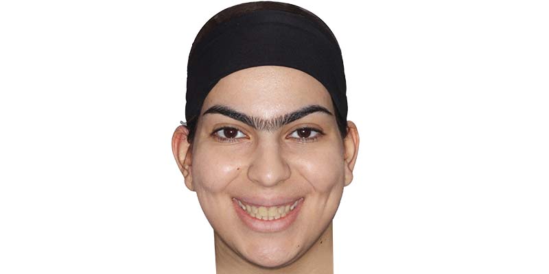 ارتودنسی اپن بایت بدون جراحی فک