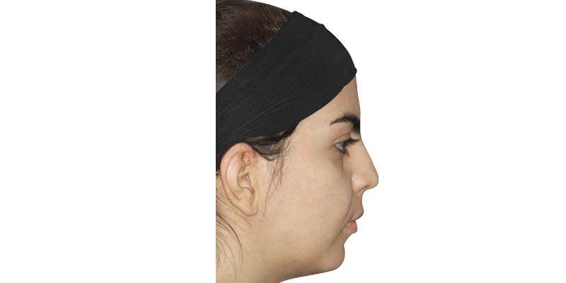 ارتودنسی اپن بایت بدون جراحی فک