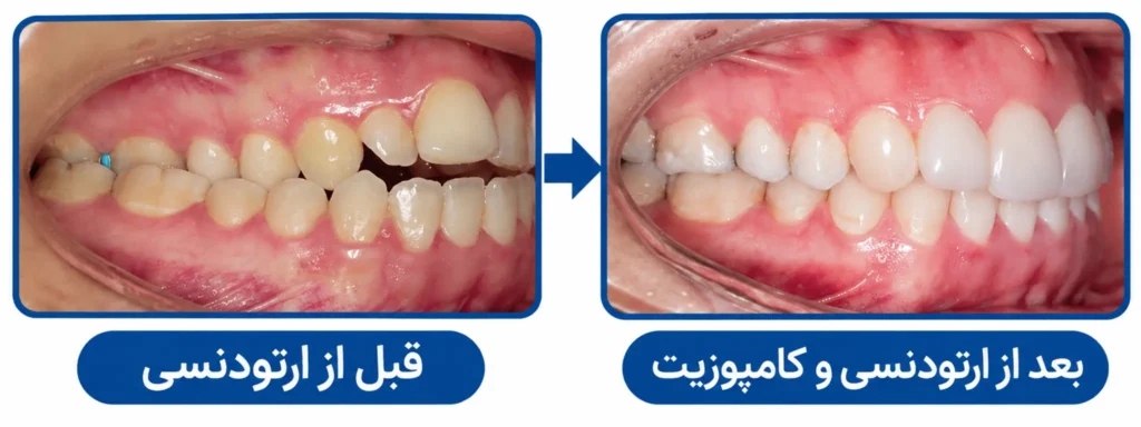 ارتودنسی بهتر است یا کامپوزیت؟