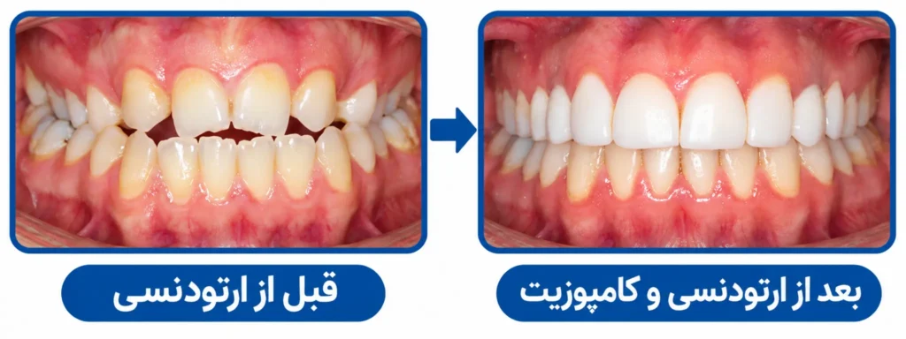 ارتودنسی بهتر است یا کامپوزیت؟