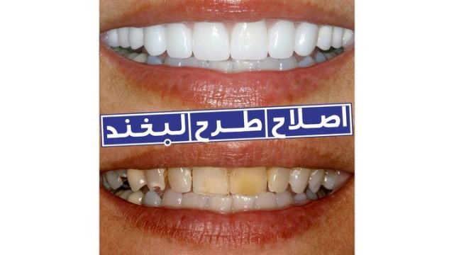 .
🔵🎥 با این که اصلاح طرح لبخند بیشتر در افرادی که ناهنجاری دندانی یا فکی دارند انجام می شود، اما نکته قابل توجه در این روش، عمومی بودن آن است. حتی افرادی که دندان های مرتبی دارند، می توانند کاندیدای اصلاح طرح لبخند باشند. گاهی با یک تغییر کوچک در رنگ دندان ها و فرم لثه ها، جذابیت بیشتری در لبخند فرد به وجود می آید.
.
👤دندانپزشك : دكتر ساسان ترابيان
.#كامپوزيت #دندانپزشک_زیبایی #كامپوزيت_ونير #اصلاح_طرح_لبخند #دندانپزشک #دندانپزشک_تهران
#پركردن_دندان #ونير_كامپوزيت #بیلدآپ_کامپوزیت
#compositeveneers #composite #dentalcomposite #smilemakeover